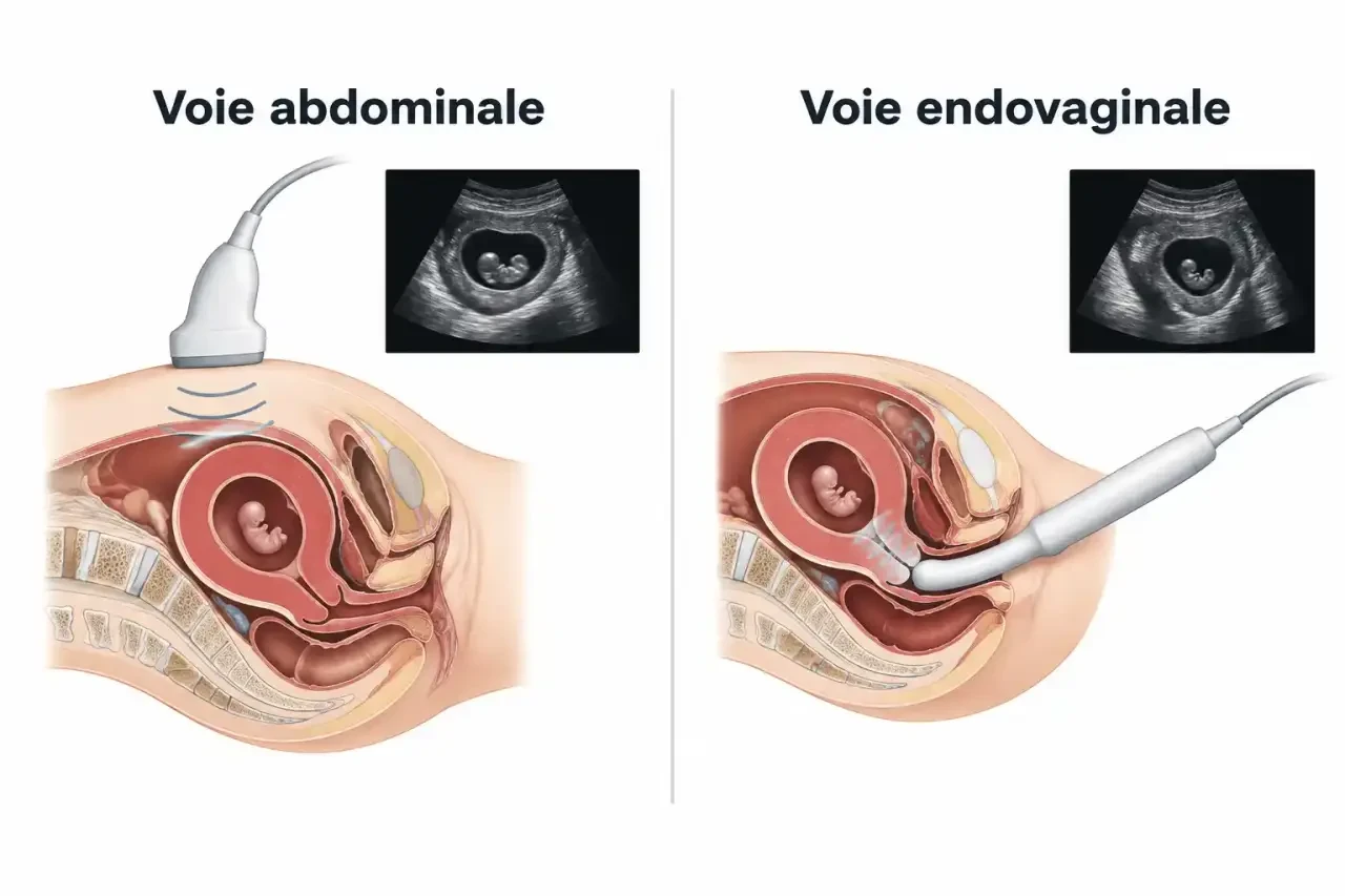 Schéma de l'écho de datation : comparaison de la voie abdominale et de la voie endovaginale